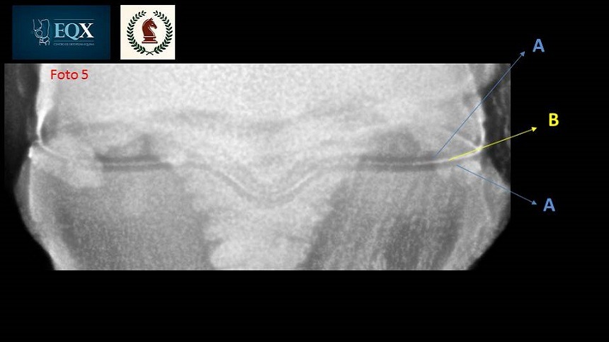 Qual é o verdadeiro espaço articular numa radiografia?